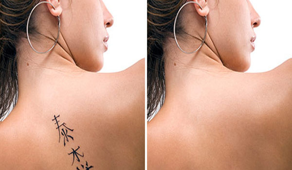 Удаление татуировок татуажа неодимовым лазером